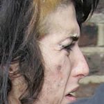 L’herpès dans la face d’Amy Winehouse
